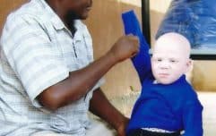 pht-cause-ministry-albino-people-tanzania